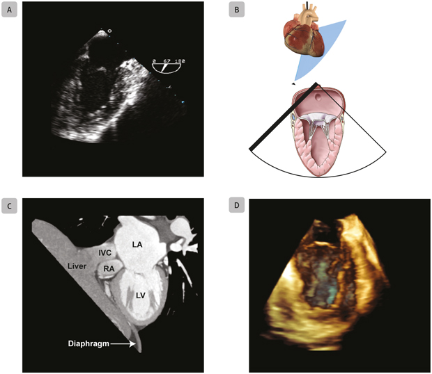 A2 Mid-Esophageal Two-Chamber Mitral Commissural Mid-esophageal two-chamber - photo 6