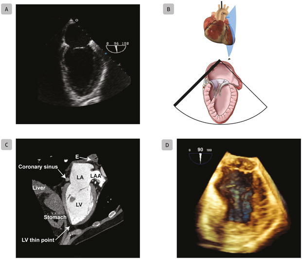 A3 Mid-Esophageal Two-Chamber Mid-esophageal two-chamber views obtained with - photo 8