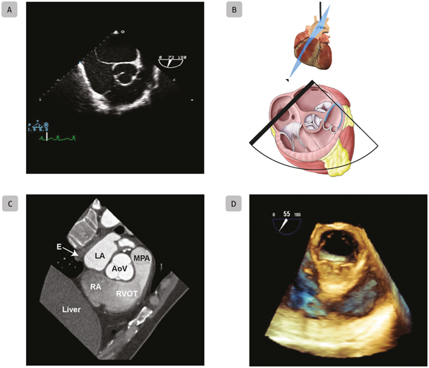 A6 Mid-Esophageal Right Ventricular Outflow Tract Mid-esophageal right - photo 15