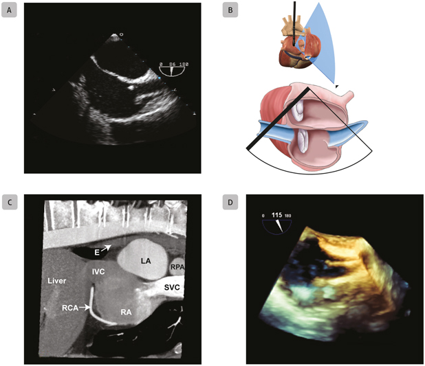 A7 Mid-Esophageal Bicaval Mid-esophageal bicaval views obtained with - photo 18