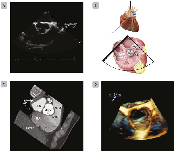 A8 Mid-Esophageal Aortic Valve Short-Axis Mid-esophageal aortic valve - photo 20