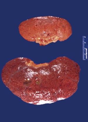 Answers Side B 1 Myocyte cellular atrophy is present as a result of - photo 7