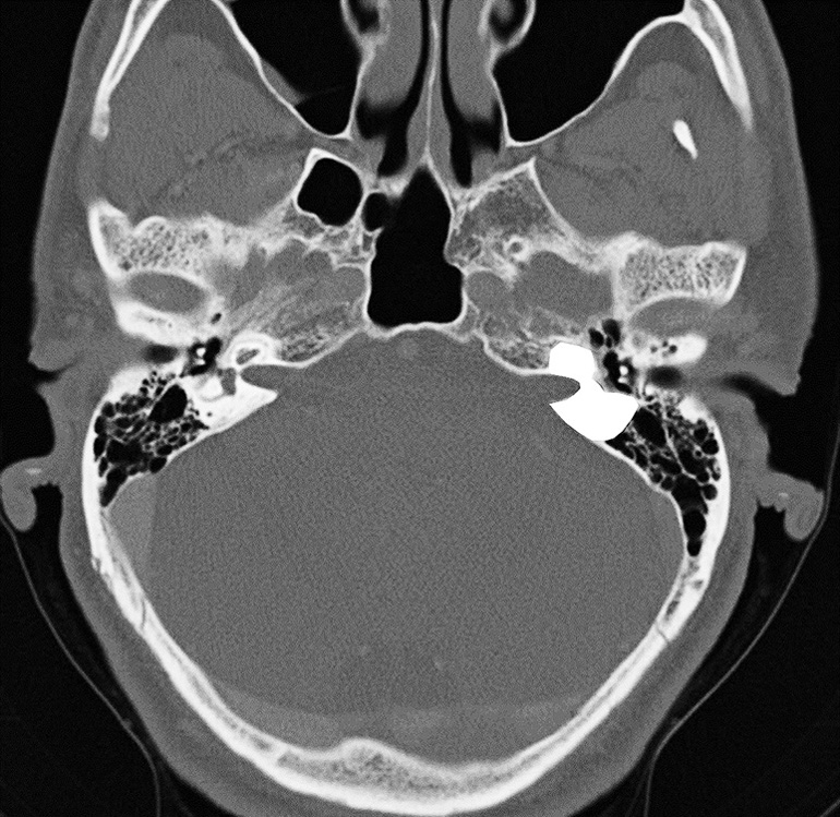 A CT scan of the skull showing the position of the otic capsule at its base - photo 4