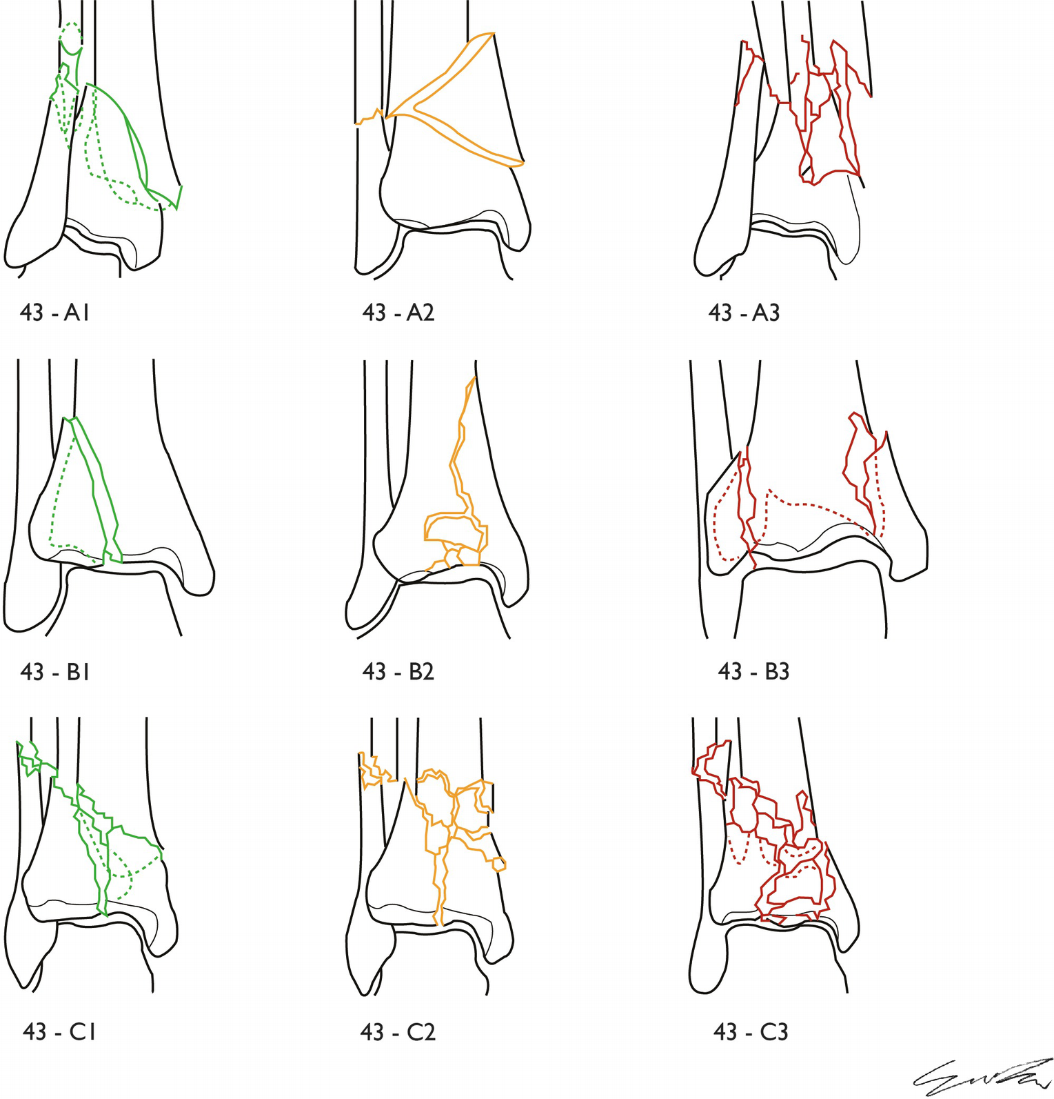 Fig 11 AO classification of the distal tibia epiphysis fractures subgroup A - photo 1