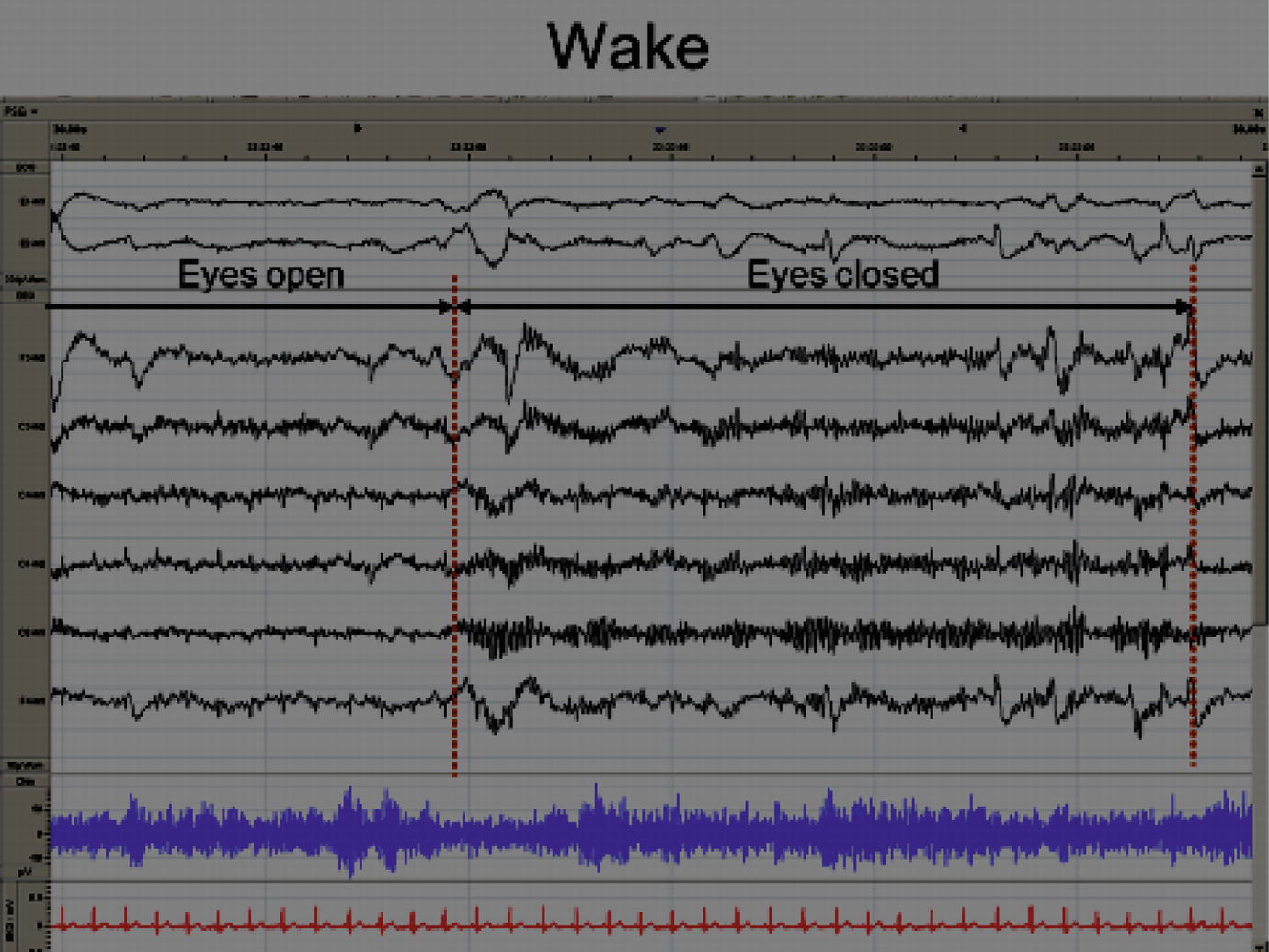 Fig 12 Wakefulness Fig 13 Wakefulness with eyes closed 122 - photo 2