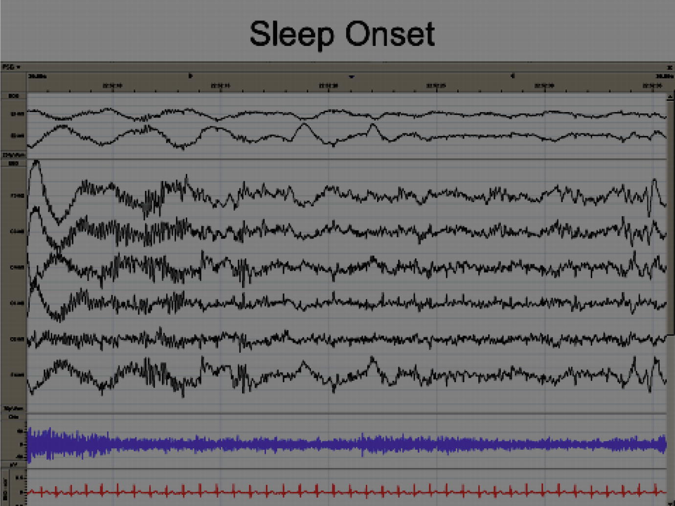 Fig 14 Sleep onset 123 Stage N1 Stage N1 the transitional stage is - photo 4