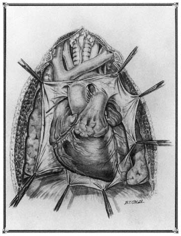 The opened normal pericardium and heart in situ The epicardial mesothelium is - photo 2