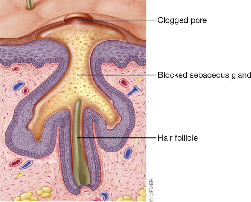 Acne develops when sebum an oily substance that lubricates your hair and skin - photo 5