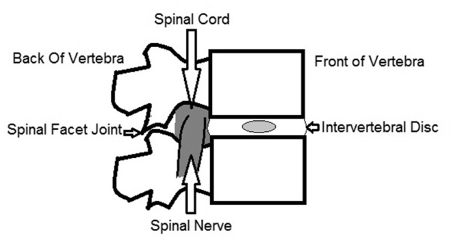 Under normal circumstances there is plenty of spacearound the spinal nerves - photo 1