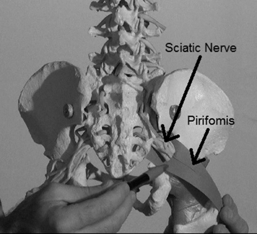 Anatomy varies somewhat from person to person andthe sciatic nerve can pass - photo 5