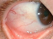 This is the patients eye as of August 2005 There is a prominent vein hanging - photo 10