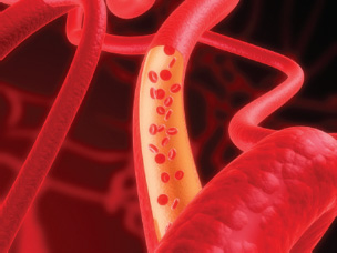 Fig I2 Blood needs to flow freely in the vessels Why Blood Slows down Many - photo 3