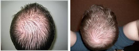 Some types of baldness can be caused due to an autoimmune disorder Alopecia - photo 2