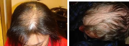 Some types of baldness can be caused due to an autoimmune disorder Alopecia - photo 3