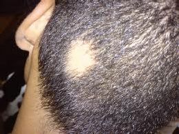 Severe forms of alopecia areata are Alopecia Totalis which causes complete - photo 4
