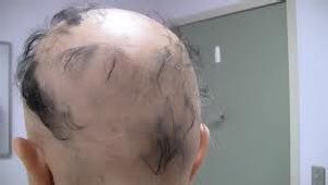 Alopecias effects are dandruff skin lesions scarring and hair loss in - photo 5
