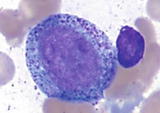 Slightly larger cells 1424 m than myeloblasts with high NC ratio 351 - photo 7