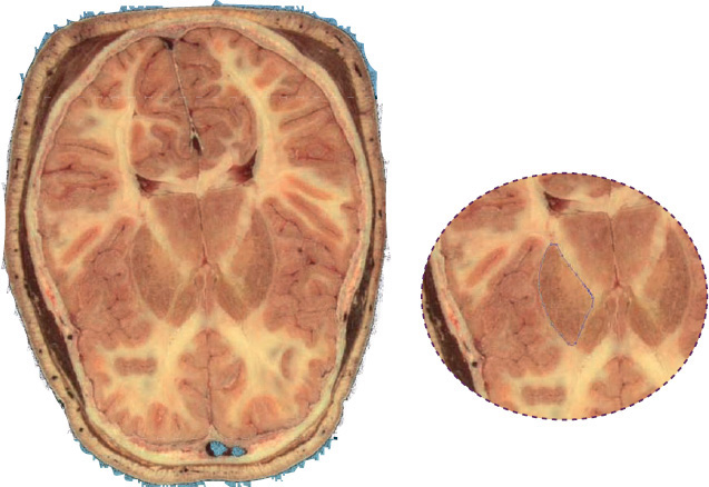 This image shows a label around the caudate nucleus of the brain on an axial - photo 16