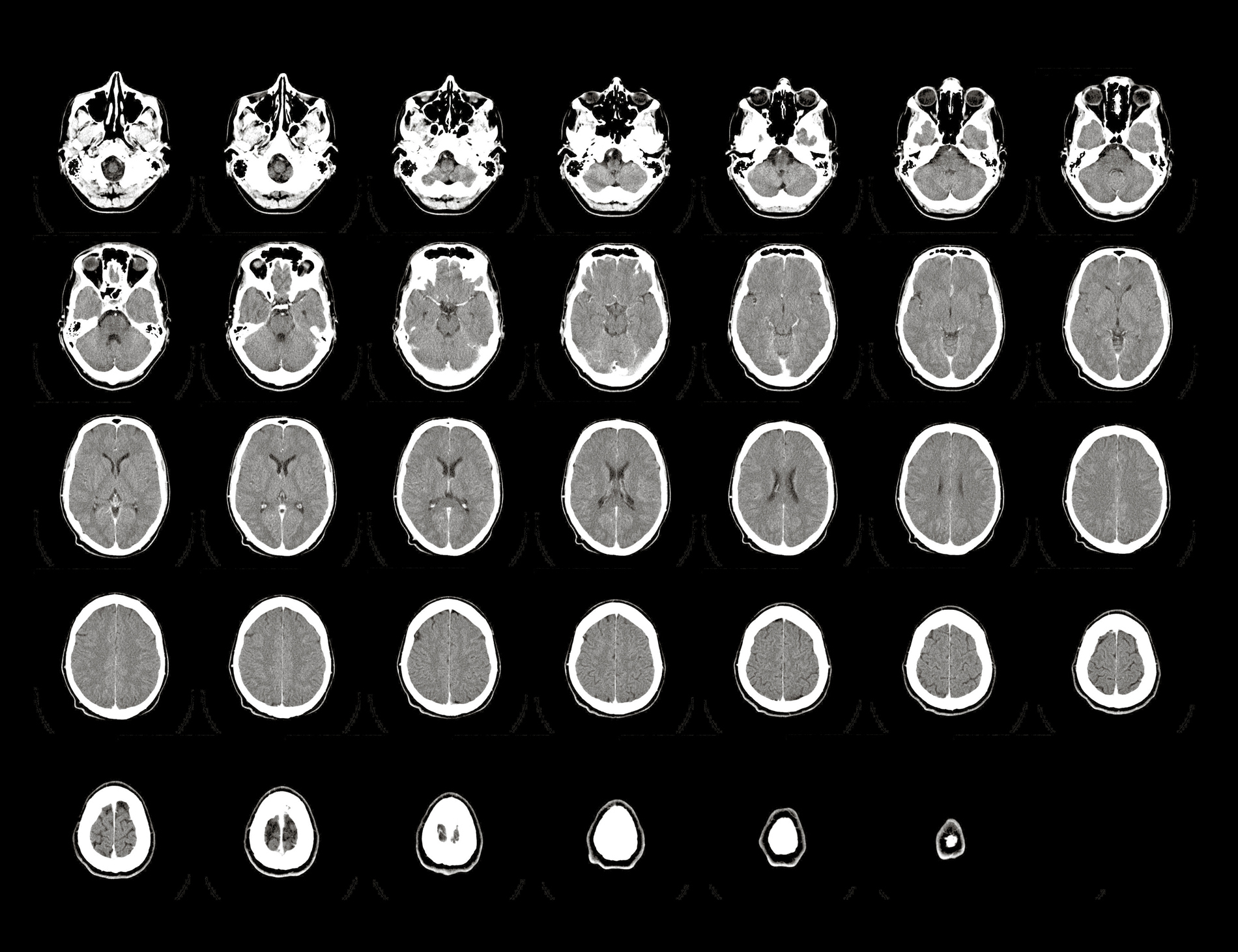 Computer tomography of a human brain from base of the skull to top after a - photo 1