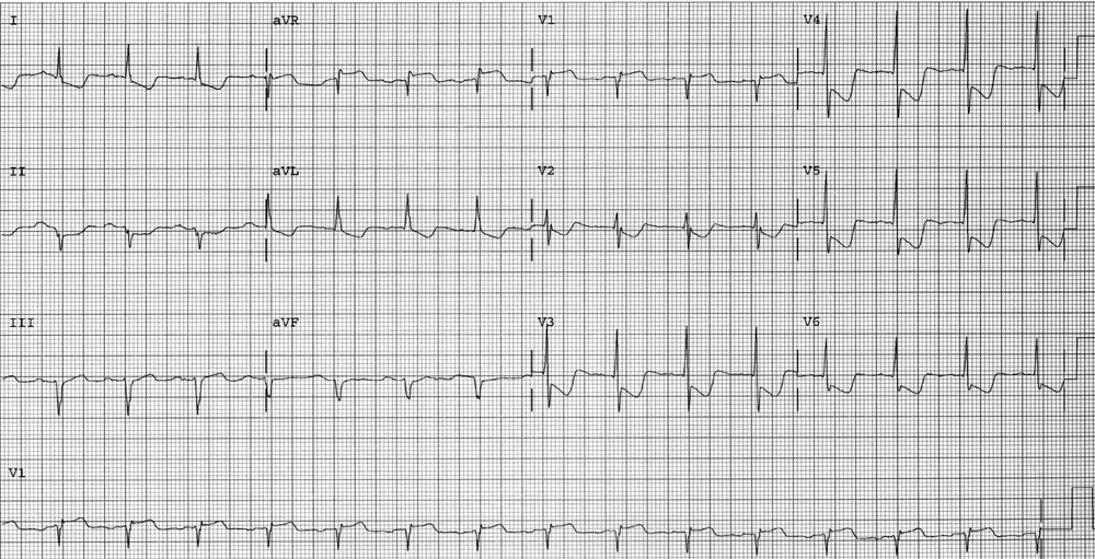 Which of the following is the most likely diagnosis Chronic stable angina - photo 1