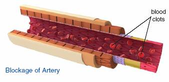 Plaque Formation Plaque is a fatty substance in the blood like cholesterol - photo 9