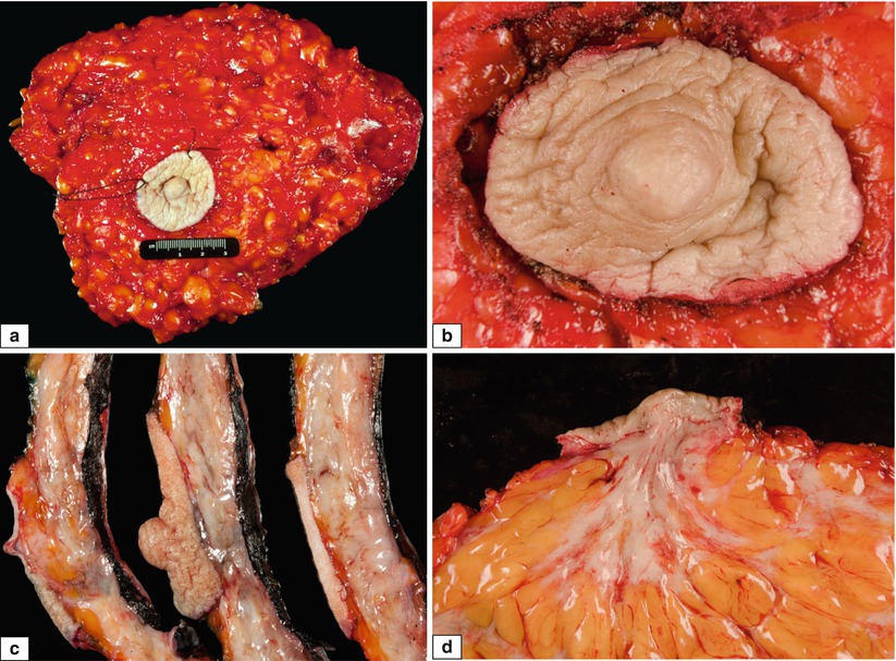 Fig 12 Normal adult female breast Gross features a Skin-sparing total - photo 2