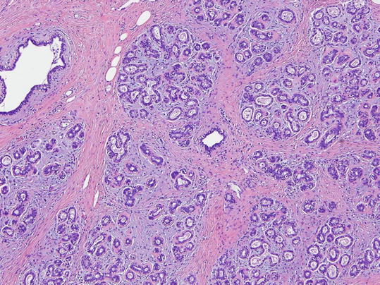 Fig 17 Normal adult female breast Histologic features Intralobular stroma - photo 8