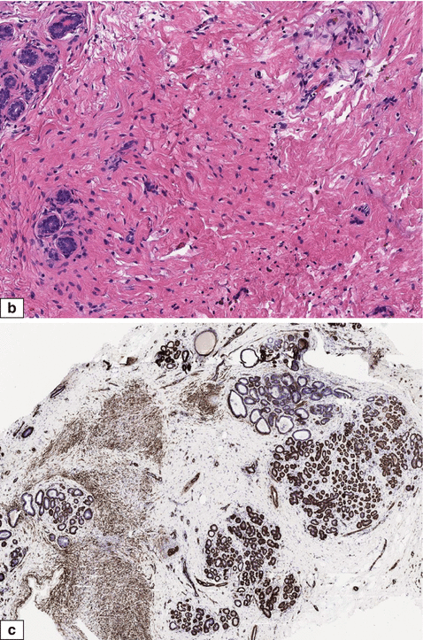 Fig 19 Normal adult female a b Stroma shows myoid cells in addition to - photo 11