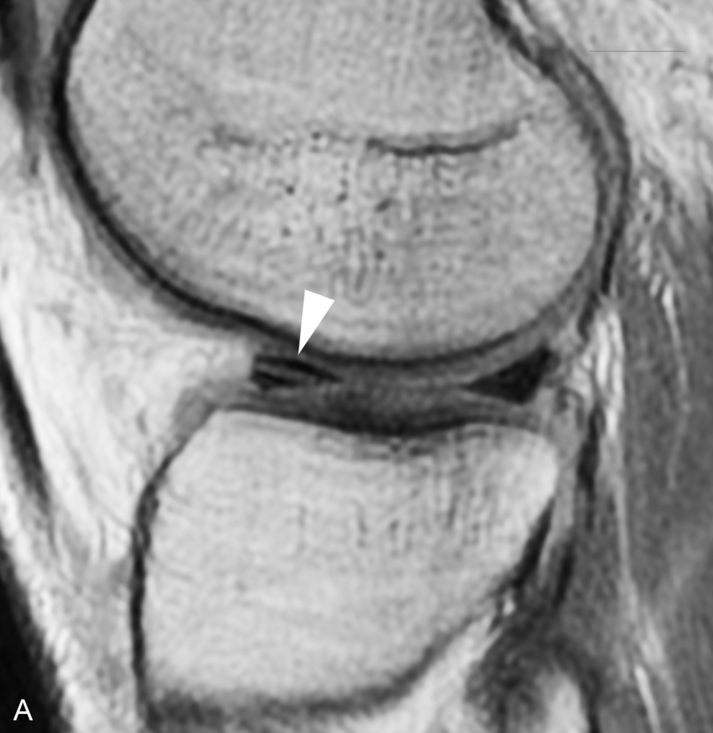 Fig 11 Effect of motion A Sagittal proton densityweighted image of the - photo 4