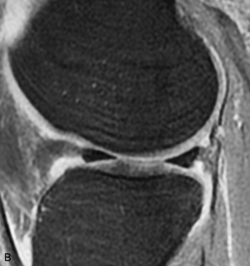 Fig 11 Effect of motion A Sagittal proton densityweighted image of the - photo 5