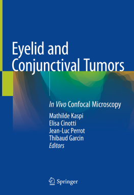 Mathilde Kaspi (editor) - Eyelid and Conjunctival Tumors: In Vivo Confocal Microscopy