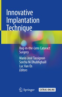 Marie-José Tassignon Innovative Implantation Technique: Bag-in-the-Lens Cataract Surgery