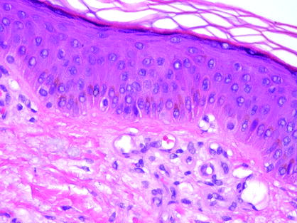 Fig 13 The stratum granulosum demonstrates keratinocytes with abundant - photo 3