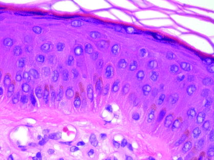 Fig 14 The basal layer demonstrates pigment-laden keratnocytes and vacuolated - photo 4