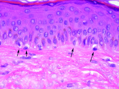 Fig 15 Cells with hyperchromatic nuclei and surrounding spaces along the - photo 5