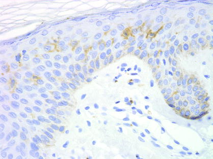 Fig 17 CD1a demonstrates the dendritic nature of the intraepidermal - photo 7