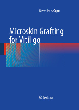 Devendra K. Gupta Microskin Grafting for Vitiligo