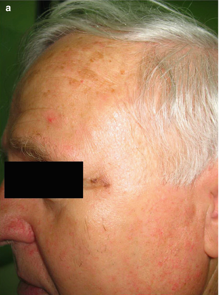 Figure 11 a Flat pigmented macule on the left temporal region of a 67-year - photo 3