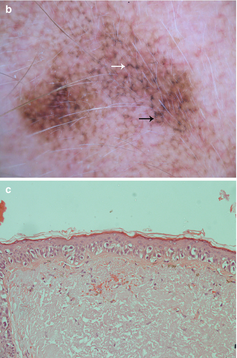 Figure 11 a Flat pigmented macule on the left temporal region of a 67-year - photo 4