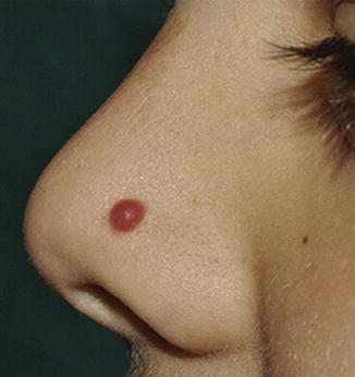 Fig 11 Characteristic appearance of a Spitz nevus as a smooth dome-shaped - photo 1