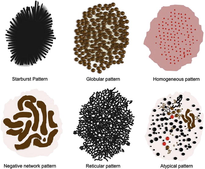 Fig 12 Common dermoscopy patterns seen in Spitz nevi Reprinted from - photo 2