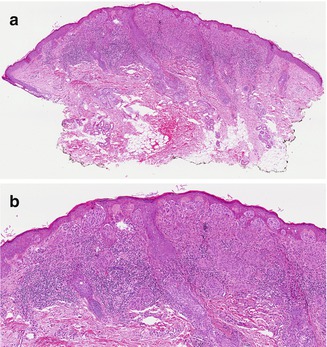 Fig 13 Spitz nevus a At low power the characteristic wedge-shaped - photo 3