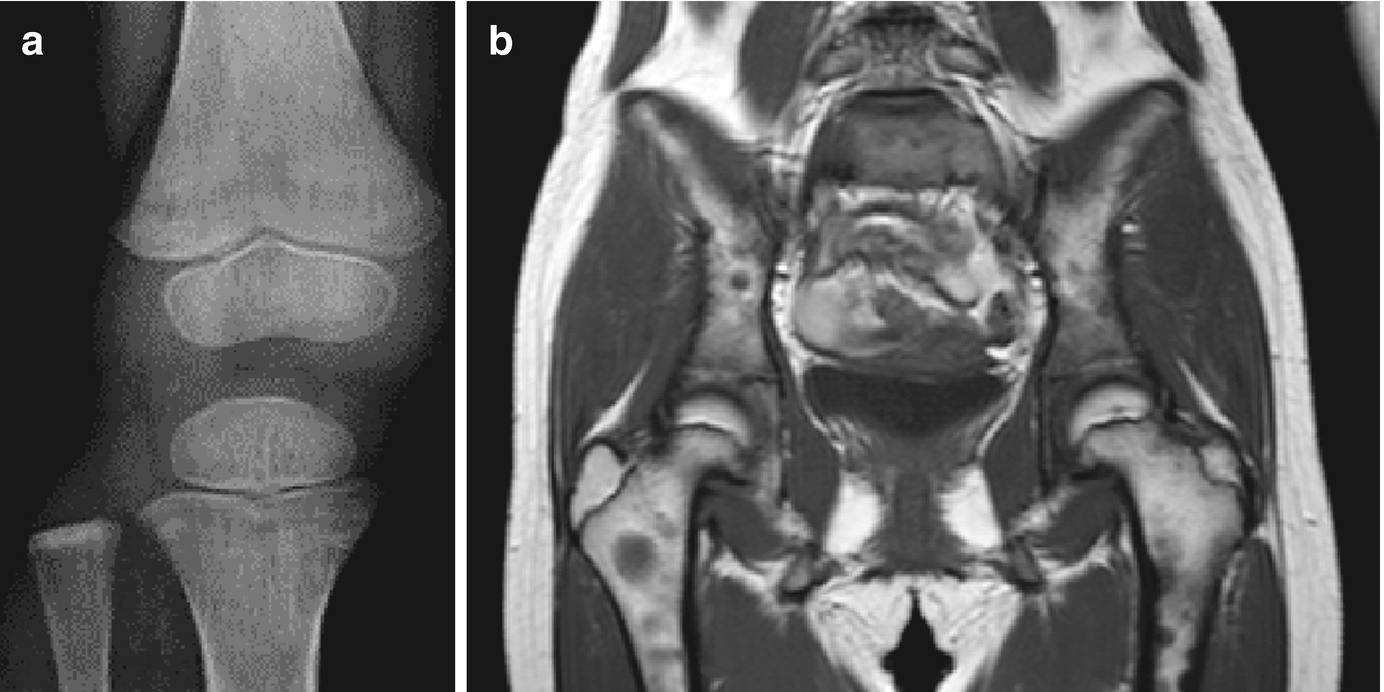 Fig 11 Imaging findings of ALL cases a X-ray findings of the knee of - photo 3