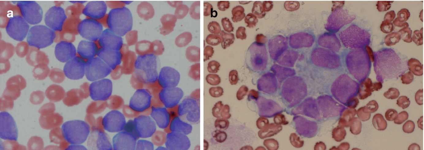 Fig 12 Typical morphology of ALL May-Giemsa staining of bone marrow - photo 4