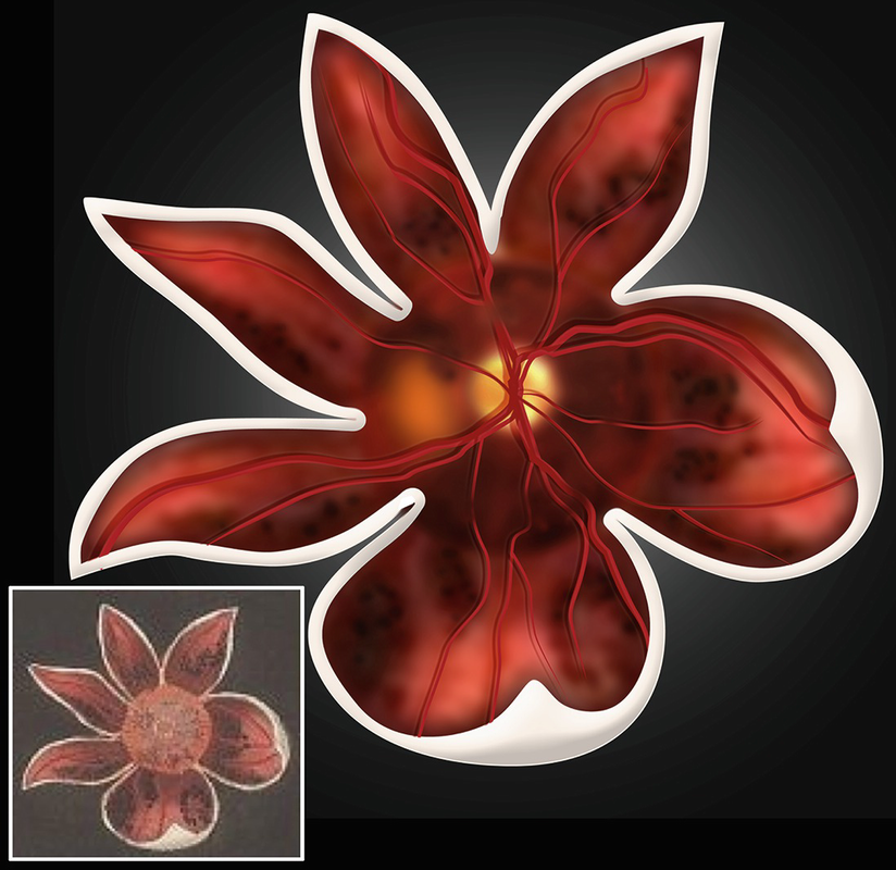 Fig 11 A pathology illustration of retina pigmentation recreated from the - photo 3