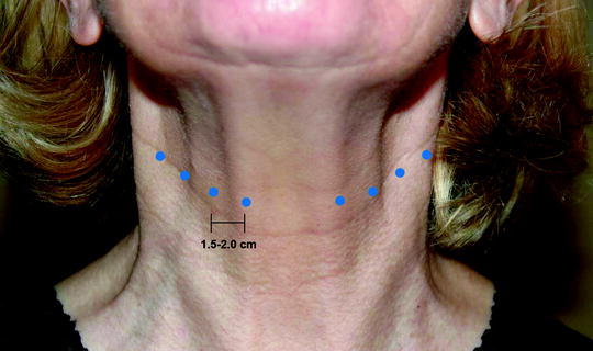 Fig 12 Injection pattern for patients with broad diffuse muscle patterns - photo 2