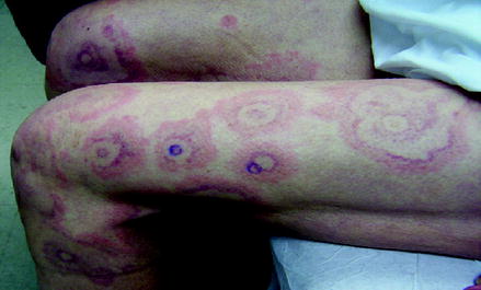 Fig 11 Targetoid erythematous to violaceous edematous lesions with central - photo 1