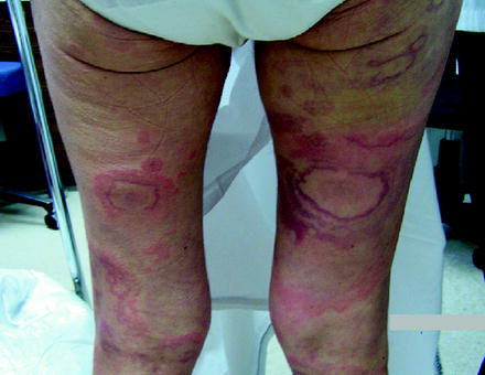 Fig 12 Targetoid erythematous to violaceous edematous lesions with central - photo 2