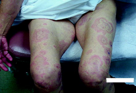 Fig 13 Targetoid erythematous to violaceous edematous lesions with central - photo 3