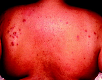 Fig 11 Acne and central obesity in Cushing syndrome Fig 12 Hirsutism - photo 1
